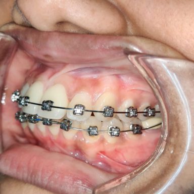 Braces