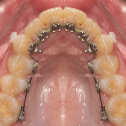Lingual Braces
