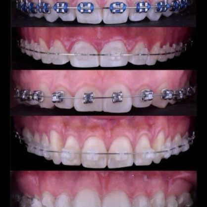 Braces and Retainers