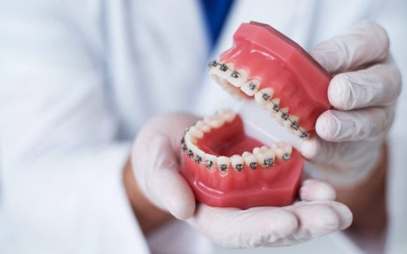 orthodontist showing Braces arrangement