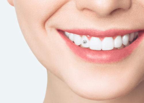 Teeth Jewellery at Smile Specialists