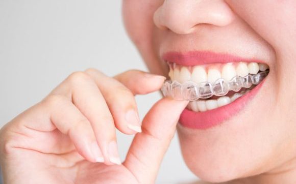 Invisalign invisible braces
