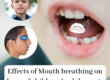 Effects of mouth breathing on faces