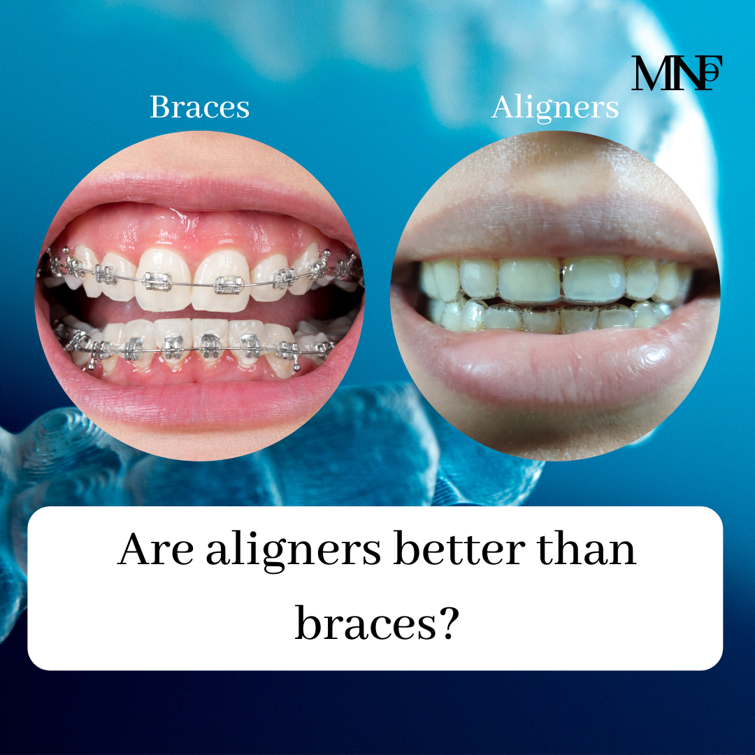 Are aligners better than braces Are aligners better than braces