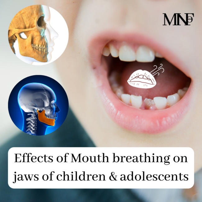 Mouth breathing effects on Jaws