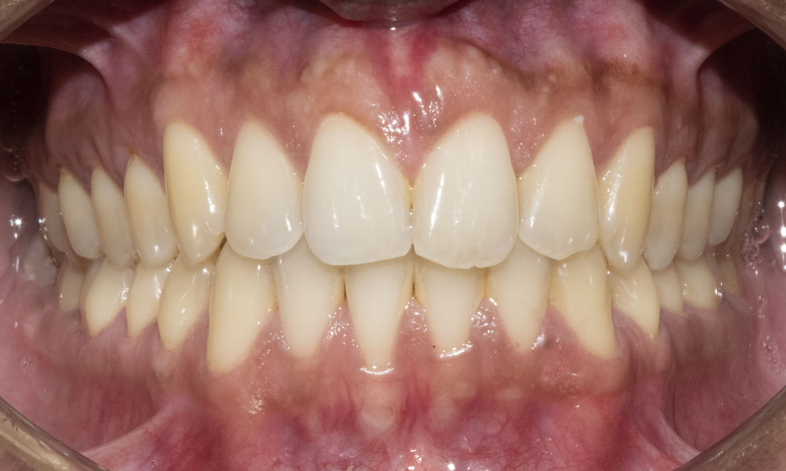 After Aligners