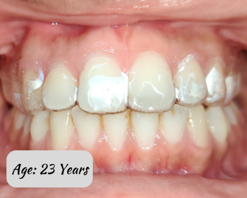 Aligners for Young Adults