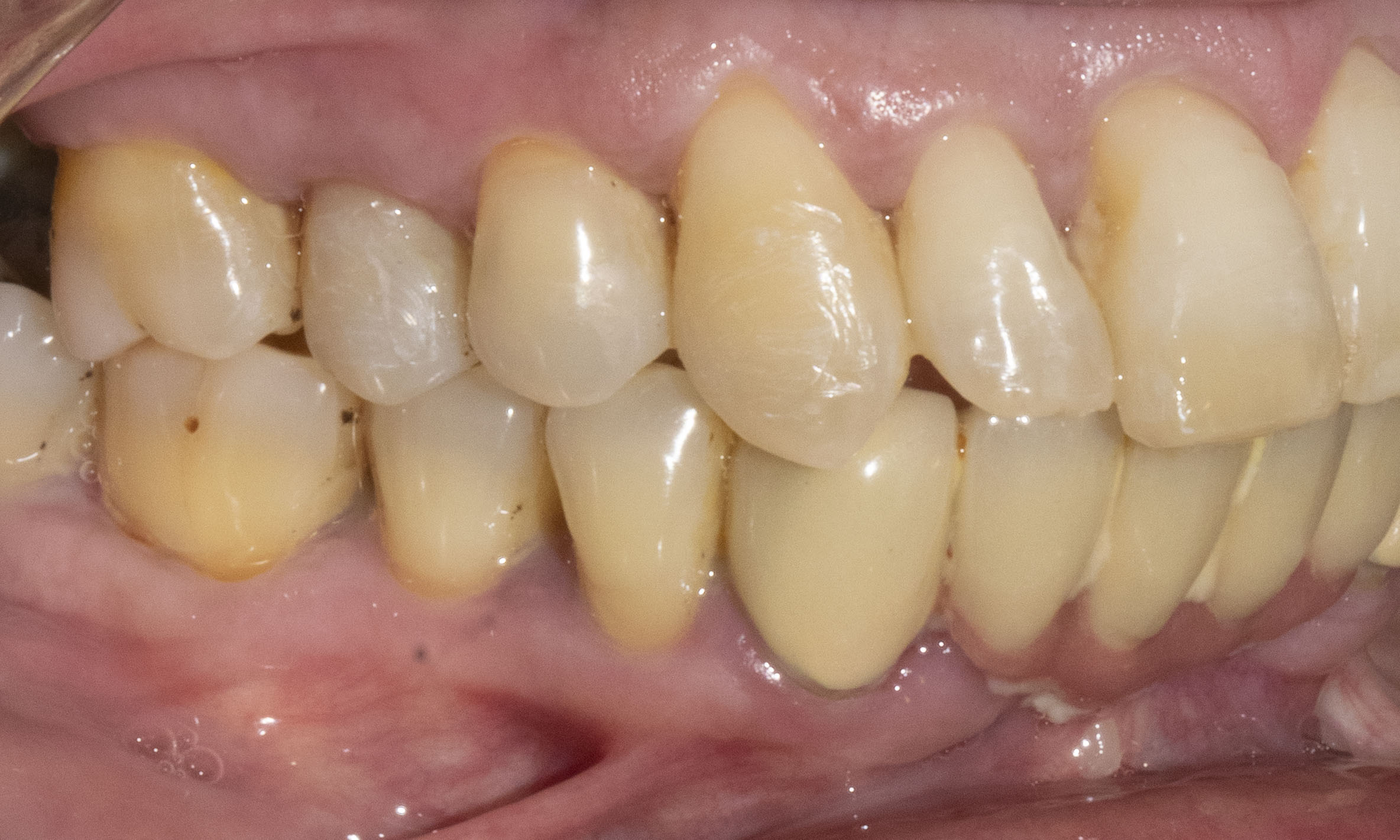 Teeth brought back with Aligners