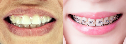 aligners and braces smile comparison
